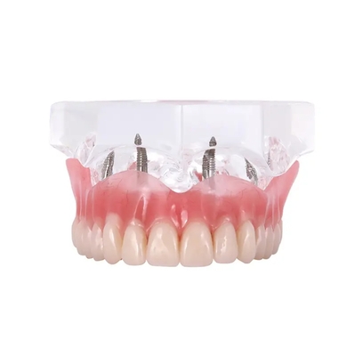 Medical Dental Upper Implants Model Overdenture with 4 Superior Teeth Demo