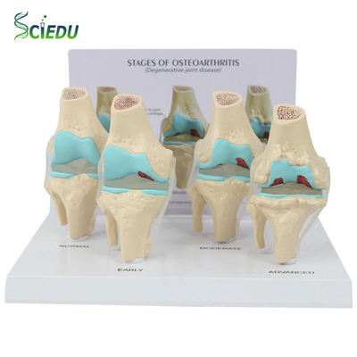 CIEDU Knee Joint Skeleton Teaching Resource Medical Human 4-stage Knee Joint Model with Back Card Diseased Knee Joint Model