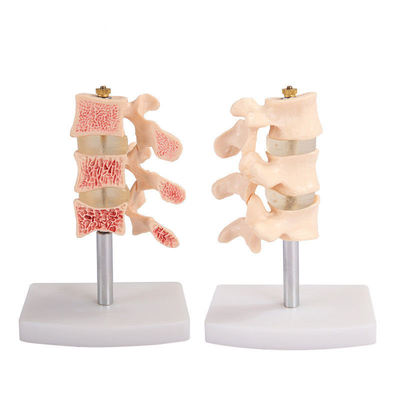 3 Parts Osteoporosis Lesion Model Spine and Cervical Dissection Joint Model Medical Anatomical Lumbar Vertebrae Model for Study