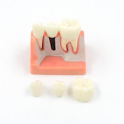 Dental Implant Model Patient Education Dental Model Teeth Anatomy Implant Crown Bridge Dental Training Model