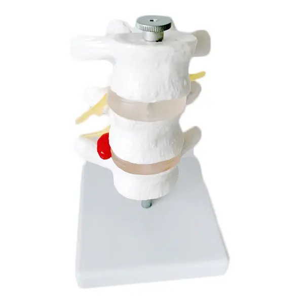 3 Vertebrae Human Lumbar Disc Herniation Model Detachable Vertebrae Spinal Column for Chiropractors